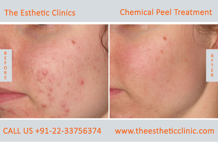Chemical Peels Treatment before after photos in mumbai india (3)